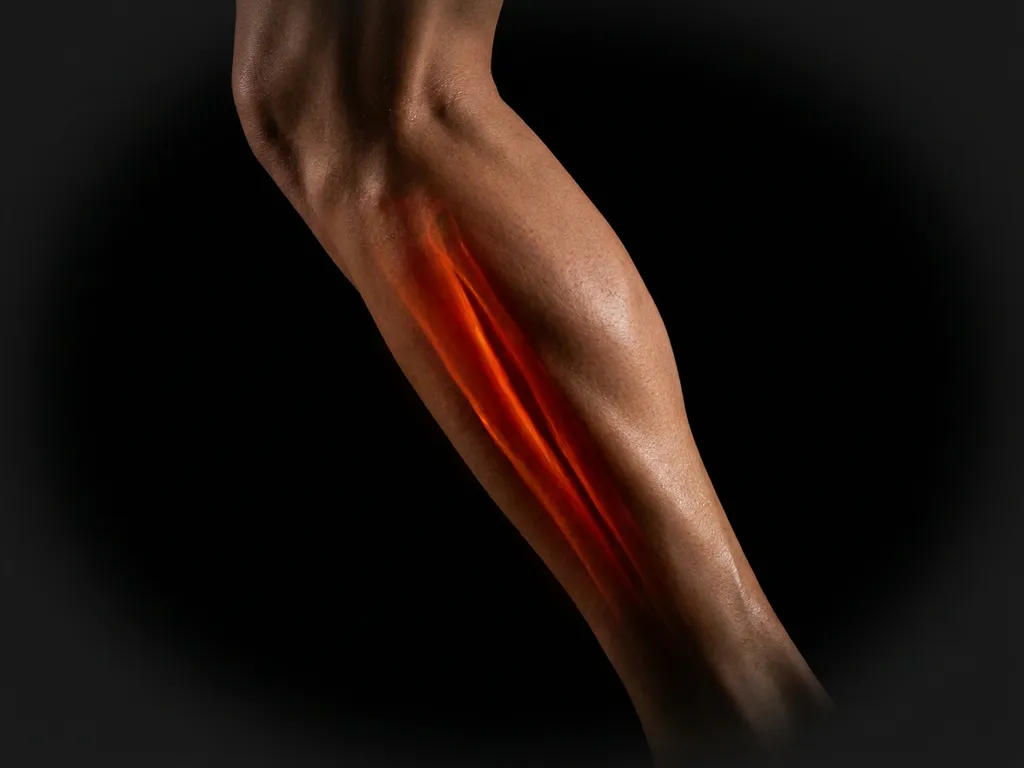 Scheenbeen van een hardloper met gloeiend rood-oranje pijnpunt langs het tibiabot, symboliseert shin splints.